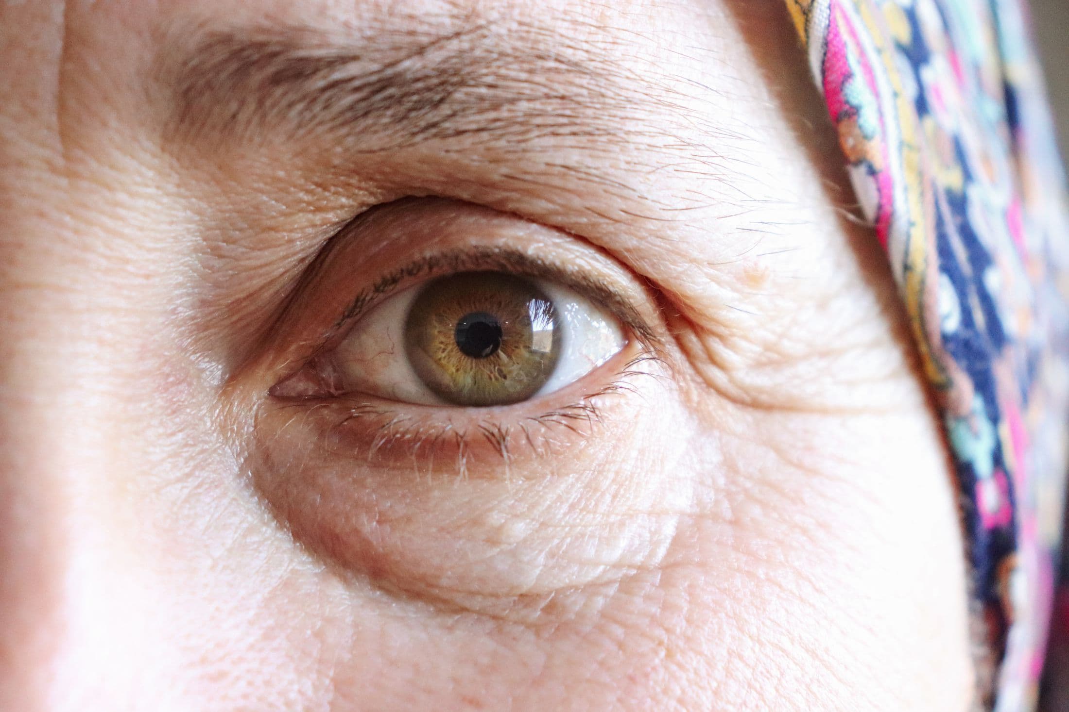 Lifting des sourcils à Bordeaux