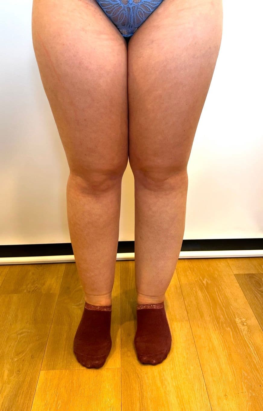 Lipedema – Compare before and after the procedure