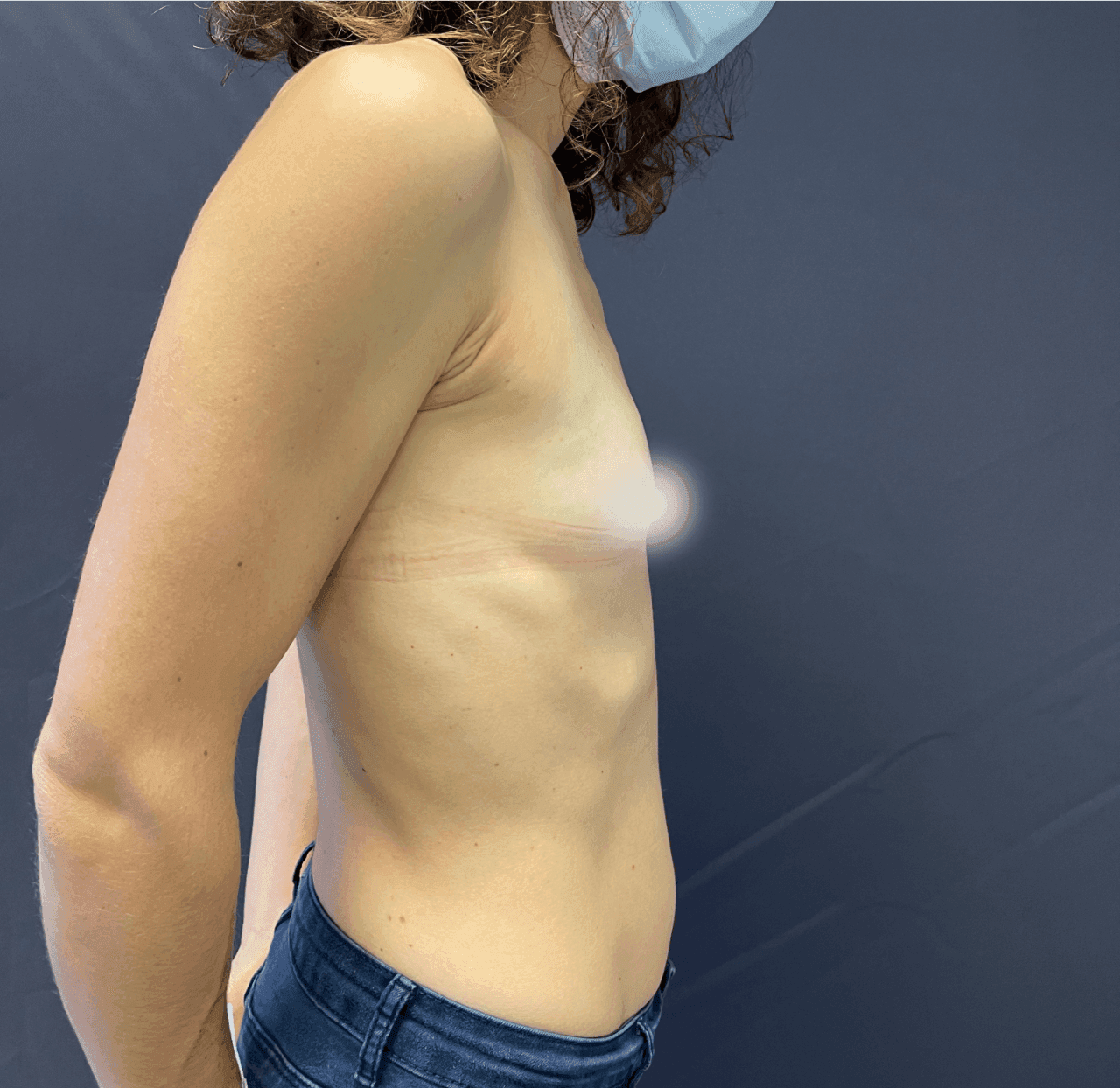 Augmentation mammaire – schéma