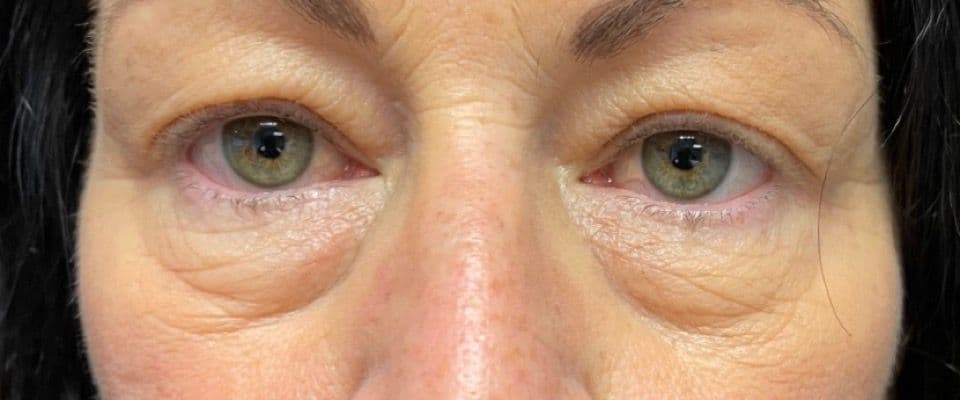 Lower blepharoplasty – Compare before and after the procedure