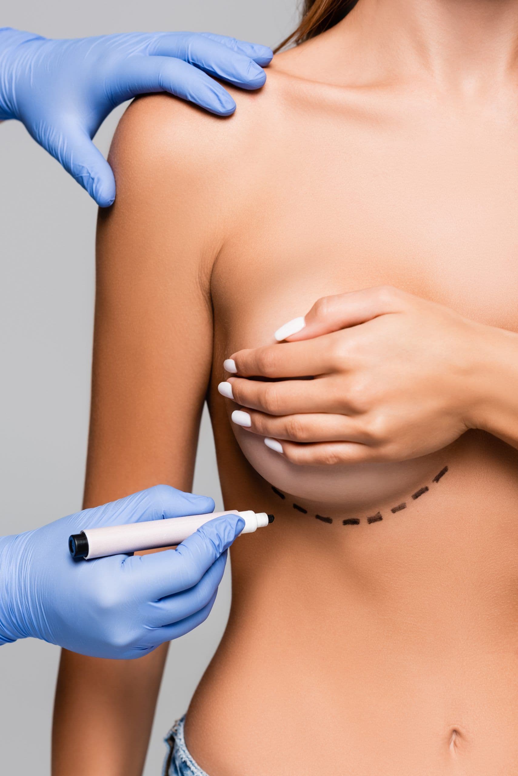 Breast lift (mastopexy) in Bordeaux