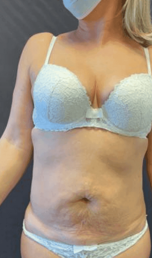 Tummy tuck – Compare before and after the procedure