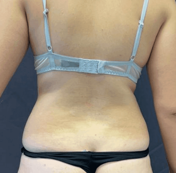 Liposuction – Compare before and after the procedure