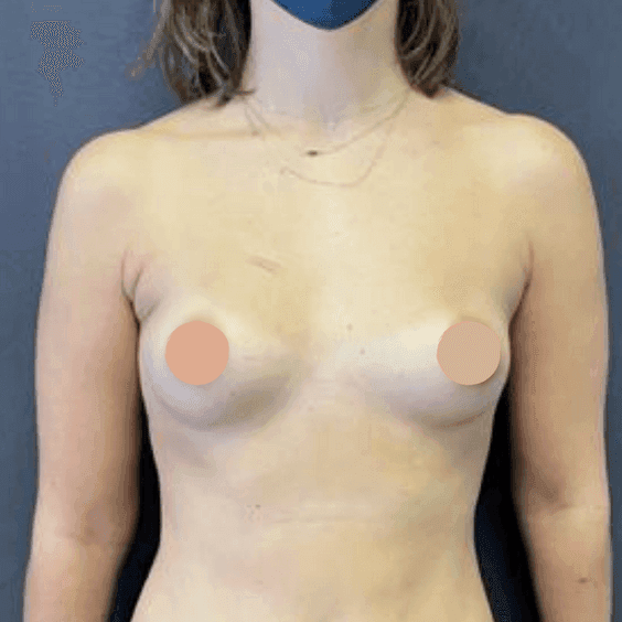 Natural breast augmentation with fat grafting – Compare before and after the procedure
