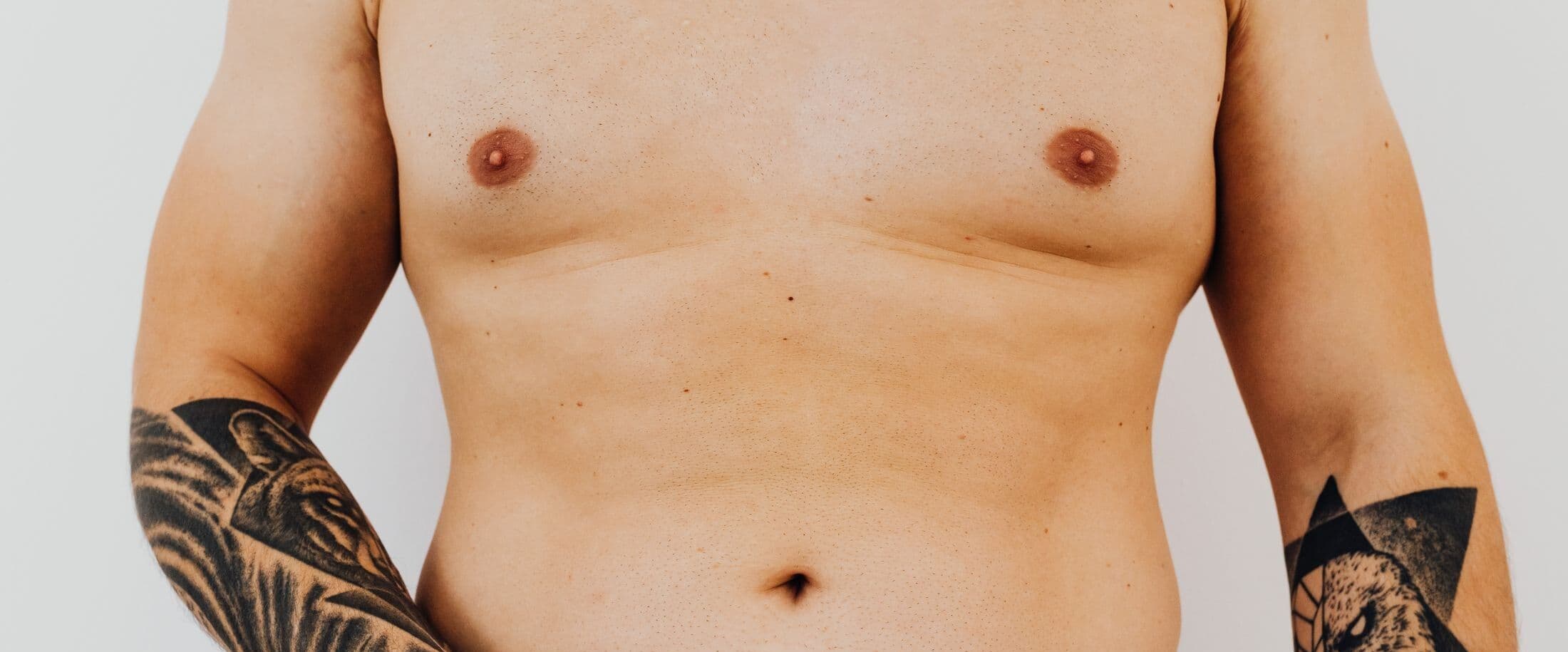 Gynecomastia