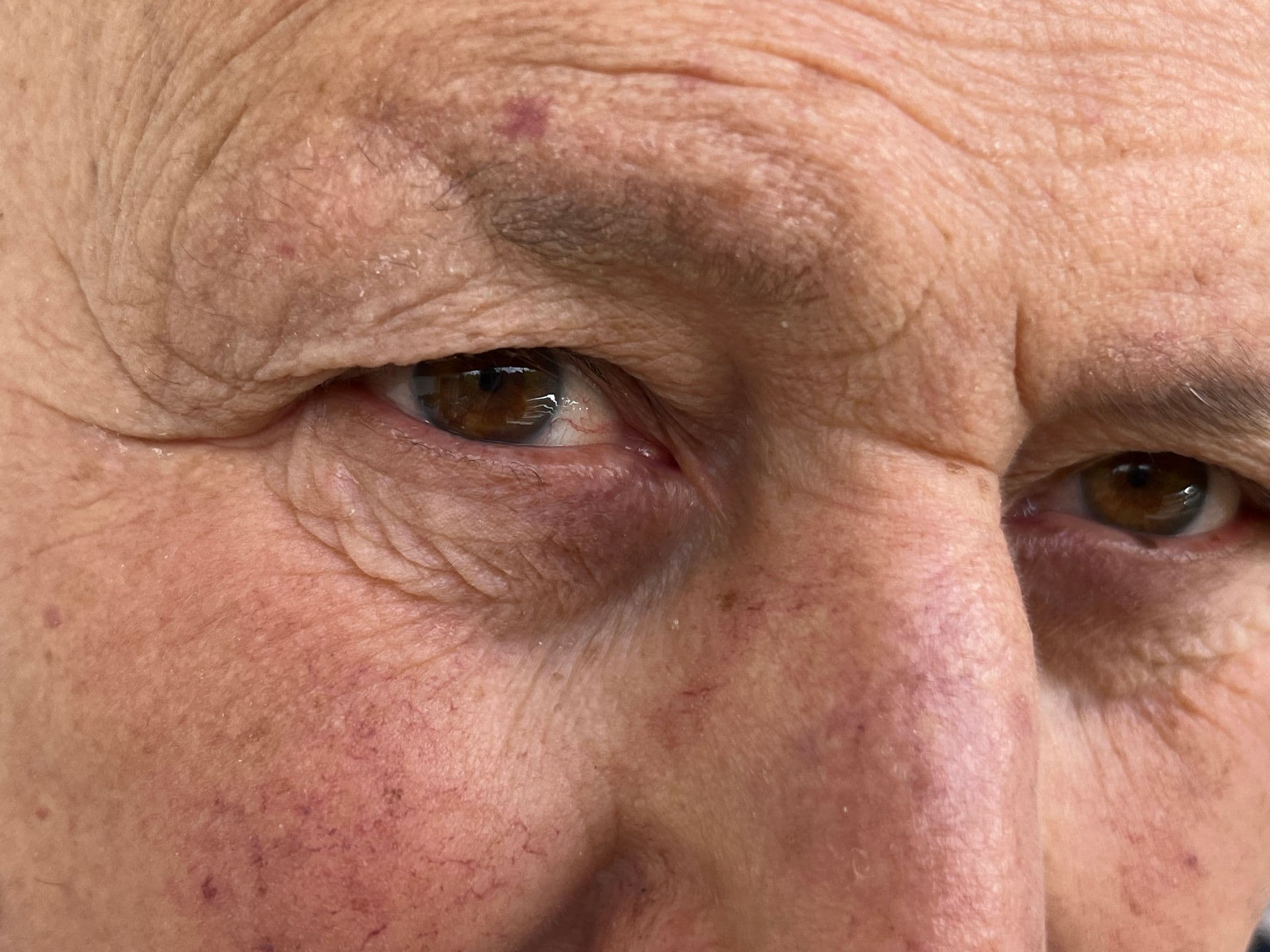 Blépharoplastie inférieure à Bordeaux